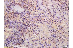 Formalin-fixed and paraffin embedded human gastric carcinoma labeled with Anti-MTF-1 Polyclonal Antibody, Unconjugated (ABIN701425) at 1:200 followed by conjugation to the secondary antibody and DAB staining (MTF1 Antikörper  (AA 101-200))