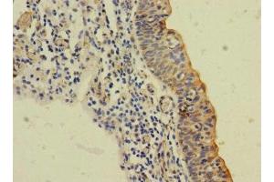 Immunohistochemistry of paraffin-embedded human bladder cancer using ABIN7169984 at dilution of 1:100 (SLC6A15 Antikörper  (AA 357-452))