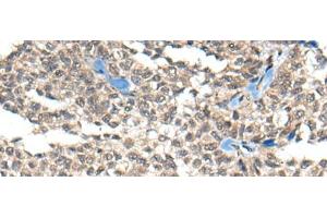 Immunohistochemistry of paraffin-embedded Human ovarian cancer tissue using REST Polyclonal Antibody at dilution of 1:50(x200) (REST Antikörper)