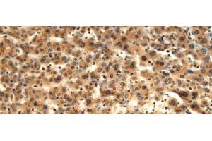 Immunohistochemistry of paraffin-embedded Human liver cancer tissue using TMOD1 Polyclonal Antibody at dilution of 1:60(x200) (Tropomodulin 1 Antikörper)