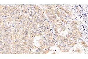 Detection of LH in Human Liver cancer Tissue using Polyclonal Antibody to Luteinizing Hormone (LH)