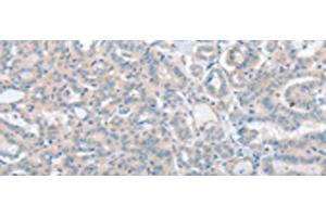 Immunohistochemistry of paraffin-embedded Human thyroid cancer tissue using SLC17A6 Polyclonal Antibody at dilution of 1:100(x200) (Solute Carrier Family 17 (Vesicular Glutamate Transporter), Member 6 (SLC17A6) Antikörper)
