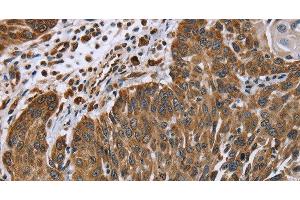 Immunohistochemistry of paraffin-embedded Human lung cancer tissue using PLXNB1 Polyclonal Antibody at dilution 1:40 (PLXNB1 Antikörper)
