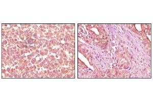 Immunohistochemical analysis of paraffin-embedded human skin carcinoma (left) and pancreas carcinoma (right) tissue, showing cytoplasmic localization using EphA2 antibody with DAB staining. (EPH Receptor A2 Antikörper)