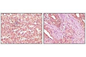 Immunohistochemical analysis of paraffin-embedded human skin carcinoma (left) and pancreas carcinoma (right) tissue, showing cytoplasmic localization using EphA2 antibody with DAB staining.