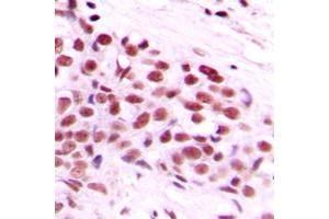 Immunohistochemical analysis of c-Myc (pT58) staining in human breast cancer formalin fixed paraffin embedded tissue section. (c-MYC Antikörper  (N-Term, pSer58))