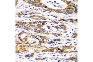 Immunohistochemistry of paraffin-embedded human gastric cancer using RPN1 antibody. (RPN1 Antikörper)