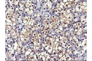 Immunohistochemical staining of paraffin-embedded Carcinoma of Human kidney tissue using anti-GSTO2 mouse monoclonal antibody. (GSTO2 Antikörper)