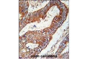 KLHL6 Antibody (C-term) (ABIN651978 and ABIN2840481) immunohistochemistry analysis in formalin fixed and paraffin embedded human colon carcinoma followed by peroxidase conjugation of the secondary antibody and DAB staining.