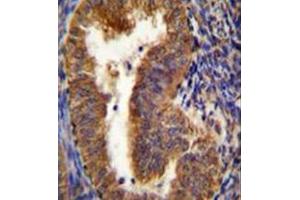 Immunohistochemistry analysis in formalin fixed and paraffin embedded human uterus tissue reacted with BNIP3L / BNIP3A Antibody (Center) followed which was followed by peroxidase conjugated to the secondary antibody and DAB staining. (BNIP3L/NIX Antikörper  (Middle Region))
