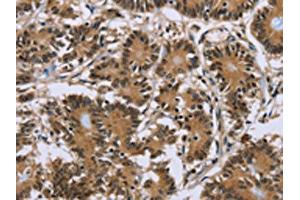 The image on the left is immunohistochemistry of paraffin-embedded Human colon cancer tissue using ABIN7191755(P2RY1 Antibody) at dilution 1/40, on the right is treated with synthetic peptide. (P2RY1 Antikörper)