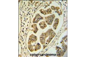 HCCS Antibody IHC analysis in formalin fixed and paraffin embedded colon carcinoma followed by peroxidase conjugation of the secondary antibody and DAB staining. (HCCS Antikörper  (AA 173-200))