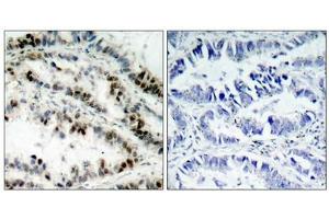 Immunohistochemical analysis of paraffin-embedded human lung carcinoma tissue using SMC1(Phospho-Ser957) Antibody(left) or the same antibody preincubated with blocking peptide(right). (SMC1A Antikörper  (pSer957))