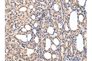 The image on the left is immunohistochemistry of paraffin-embedded Human thyroid cancer tissue using ABIN7127988(PPIL1 Antibody) at dilution 1/30, on the right is treated with fusion protein. (PPIL1 Antikörper)