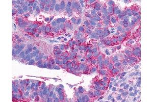 Anti-NTSR2 / NTR2 antibody IHC of human Ovary, Carcinoma.