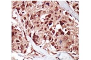 IHC analysis of FFPE human breast carcinoma tissue stained with the BRD4 antibody (BRD4 Antikörper  (AA 1-30))