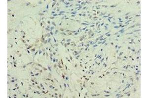 Immunohistochemistry of paraffin-embedded human breast cancer using ABIN7157755 at dilution of 1:100