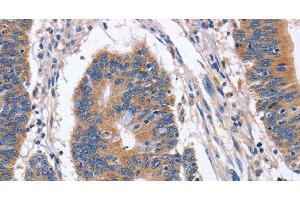 Immunohistochemistry of paraffin-embedded Human colon cancer tissue using BMP6 Polyclonal Antibody at dilution 1:40 (BMP6 Antikörper)