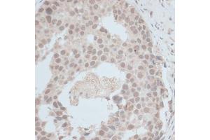 Immunohistochemistry of paraffin-embedded human breast cancer using ZNF703 antibody (ABIN7271524) at dilution of 1:100 (40x lens). (ZNF703 Antikörper  (AA 160-290))