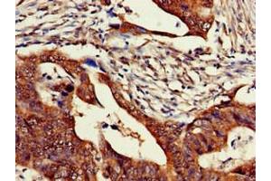 Immunohistochemistry of paraffin-embedded human colon cancer using ABIN7176539 at dilution of 1:100 (Zinc Finger Protein 816A (ZNF816A) (AA 1-200) Antikörper)