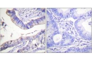 Immunohistochemistry analysis of paraffin-embedded human colon carcinoma tissue, using BCL-2 (Ab-69) Antibody. (Bcl-2 Antikörper  (AA 46-95))