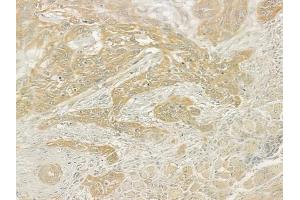 ABIN6261103 and ABIN6276877 at 1/100 staining human tongue carcinoma by IHC-P. (Cathepsin K Antikörper  (N-Term))