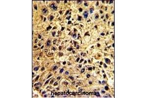 Formalin-fixed and paraffin-embedded human hepatocarcinoma with NUP62 Antibody (C-term ), which was peroxidase-conjugated to the secondary antibody, followed by DAB staining. (NUP62 Antikörper  (C-Term))