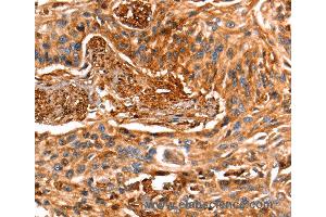 Immunohistochemistry of Human esophagus cancer using LGALS1 Polyclonal Antibody at dilution of 1:25 (LGALS1/Galectin 1 Antikörper)