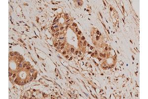 ABIN6269405 at 1/50 staining human colon cancer tissue sections by IHC-P.