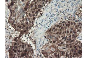 Immunohistochemical staining of paraffin-embedded Carcinoma of Human lung tissue using anti-ADH7 mouse monoclonal antibody. (ADH7 Antikörper)