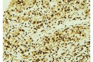 ABIN6276713 at 1/100 staining Human breast cancer tissue by IHC-P. (CDK6 Antikörper  (N-Term))