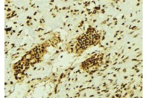 ABIN6274457 at 1/100 staining Human breast cancer tissue by IHC-P. (EZH1 Antikörper  (Internal Region))