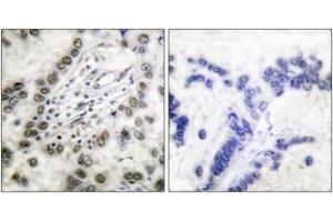 Immunohistochemistry analysis of paraffin-embedded human lung carcinoma tissue, using CBP (Ab-1535) Antibody. (CBP Antikörper  (AA 1501-1550))