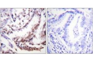 Immunohistochemistry analysis of paraffin-embedded human lung carcinoma tissue, using Histone H3 (Acetyl-Lys9) Antibody. (Histone 3 Antikörper  (H3K9ac))