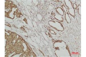 Immunohistochemistry (IHC) analysis of paraffin-embedded Human Breast Carcicnoma using ERK 3 Polyclonal Antibody. (MAPK6 Antikörper)