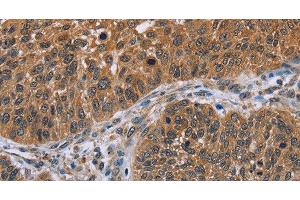 Immunohistochemistry of paraffin-embedded Human lung cancer tissue using IHH Polyclonal Antibody at dilution 1:30 (Indian Hedgehog Antikörper)