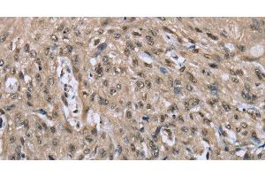 Immunohistochemistry of paraffin-embedded Human esophagus cancer tissue using DYNLL1 Polyclonal Antibody at dilution 1:30