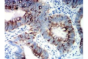 Immunohistochemical analysis of paraffin-embedded colon cancer tissues using KRT20 mouse mAb with DAB staining. (KRT20 Antikörper  (AA 1-150))