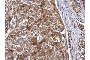 IHC-P Image Cullin 7 antibody [C2C3], C-term detects Cullin 7 protein at cytoplasm in human cervical carcinoma by immunohistochemical analysis.