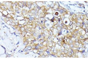 Immunohistochemistry of paraffin-embedded Human mammary cancer using EIF3L Polyclonal Antibody at dilution of 1:100 (40x lens). (EIF3L Antikörper)