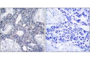 Immunohistochemistry analysis of paraffin-embedded human breast carcinoma tissue, using ZAP-70 (Ab-493) Antibody. (ZAP70 Antikörper  (AA 460-509))