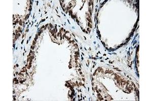 Immunohistochemical staining of paraffin-embedded Carcinoma of liver tissue using anti-PTPRE mouse monoclonal antibody. (PTPRE Antikörper)