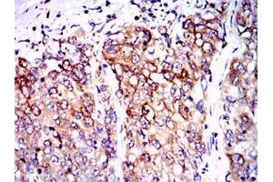 Immunohistochemical analysis of paraffin-embedded lung cancer tissues using PPP2R4 mouse mAb with DAB staining. (PPP2R4 Antikörper)