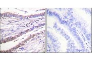 Immunohistochemistry analysis of paraffin-embedded human lung carcinoma tissue, using Cyclin A Antibody. (Cyclin A Antikörper  (AA 221-270))