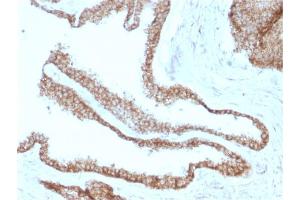 Formalin-fixed, paraffin-embedded human Prostate Carcinoma stained with Catenin, gamma Mouse Monoclonal Antibody (CTNG/1664) (JUP Antikörper)