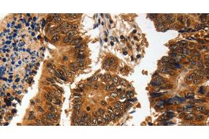 Immunohistochemistry of paraffin-embedded Human colon cancer using ADAP1 Polyclonal Antibody at dilution of 1:60 (ADAP1 Antikörper)