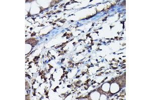 Immunohistochemistry of paraffin-embedded human colon using G Rabbit pAb (ABIN6129931, ABIN6137010, ABIN6137011 and ABIN6217659) at dilution of 1:100 (40x lens). (APOBEC3G Antikörper  (AA 60-330))