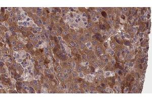 ABIN6277373 at 1/100 staining Human liver cancer tissue by IHC-P. (Connexin 31 Antikörper  (C-Term))