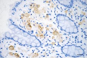 Immunohistochemistry was performed on paraffin-embedded human sigmoid colon carcinoma using JNK1 antibody (ABIN7799457), 1:200). (Rekombinanter JNK Antikörper)
