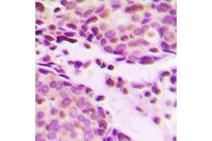Immunohistochemical analysis of Histone H2B (AcK12) staining in human breast cancer formalin fixed paraffin embedded tissue section. (Histone H2B Antikörper  (acLys12, N-Term))